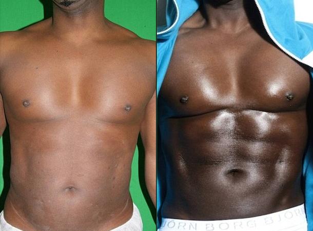 donovan-nelson-pec-implants-liposuction-3